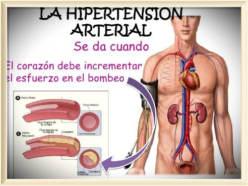 hipertensión arterial